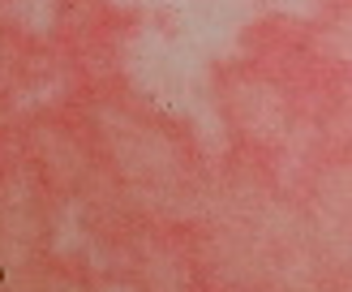 紅斑狼瘡(Lupus Erythematosus)