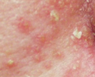 脂漏性皮膚炎 (Seborrhoeic Dermatitis)