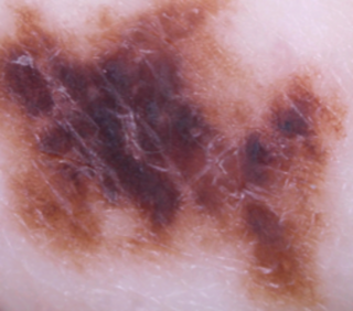皮膚癌 (Skin cancers)