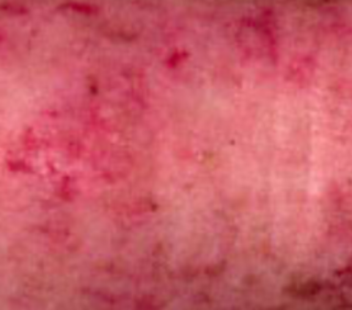 濕疹 (Atopic Dermatitis)